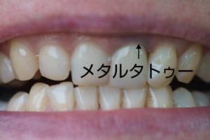 瑞穂市　歯医者　歯ぐきピーリング　吉田歯科医院