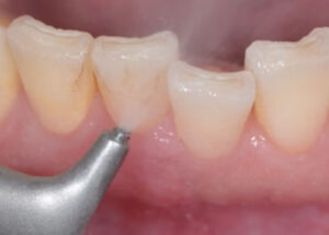 瑞穂市　歯医者　エアフロー　吉田歯科医院