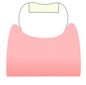 瑞穂市　歯医者　インレー修復　吉田歯科医院