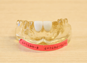 オールセラミック｜ホワイトエッセンス吉田