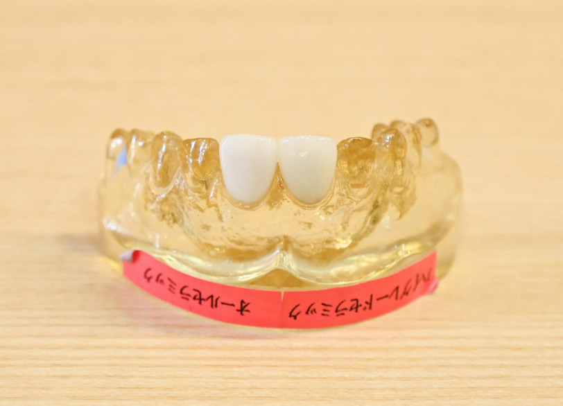 オールセラミック｜ホワイトエッセンス吉田