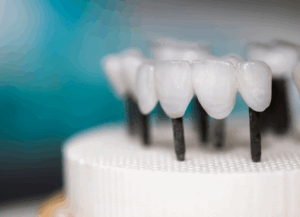 ジルコニア｜ホワイトエッセンス吉田