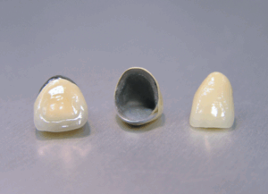 メタルボンド｜ホワイトエッセンス吉田