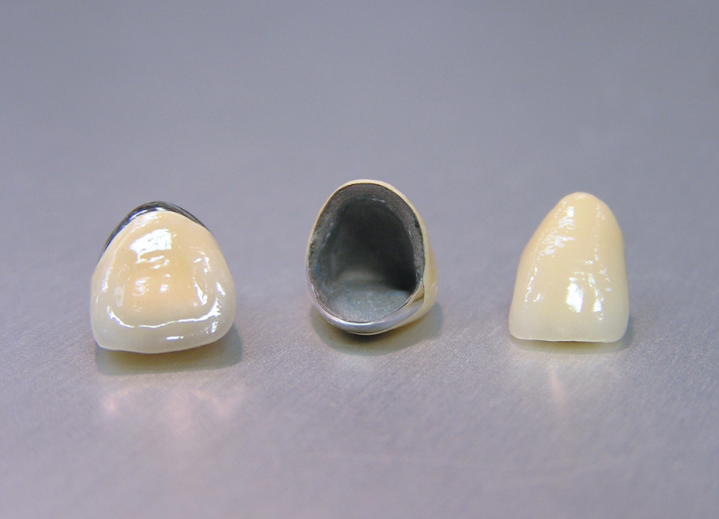 メタルボンド｜ホワイトエッセンス吉田