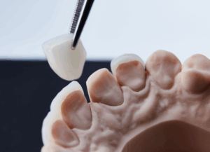 ラミネートベニア｜ホワイトエッセンス吉田