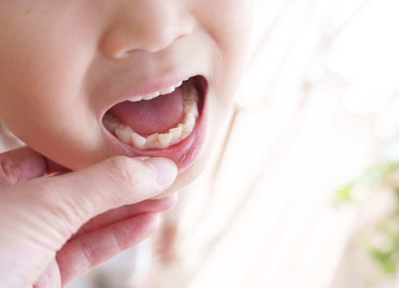 小児矯正治療の目的|ホワイトエッセンス吉田