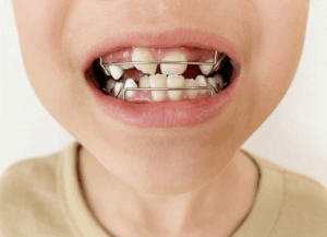 顎の成長発育を活用した治療｜ホワイトエッセンス吉田