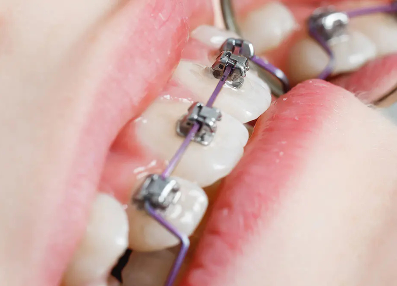 部分矯正｜ホワイトエッセンス吉田