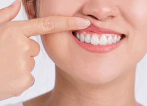 歯ぐきピーリングのメリット｜ホワイトエッセンス吉田