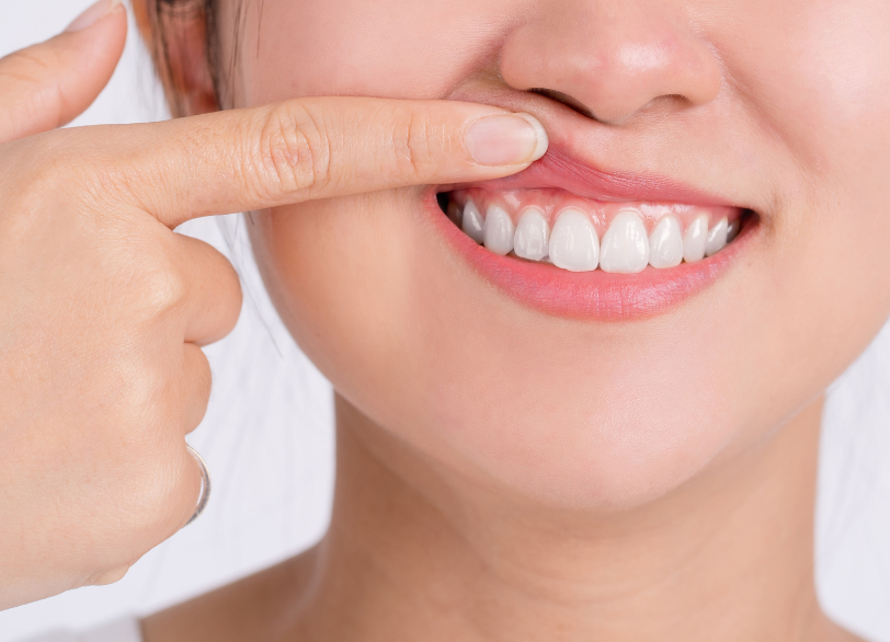 歯ぐきピーリングのメリット｜ホワイトエッセンス吉田
