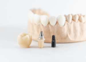 インプラントでしっかり噛める歯｜ホワイトエッセンス吉田