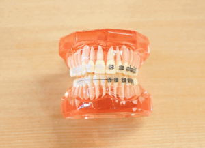 矯正装置｜ホワイトエッセンス吉田