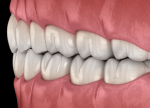 噛み合わせ治療のメリット｜ホワイトエッセンス吉田