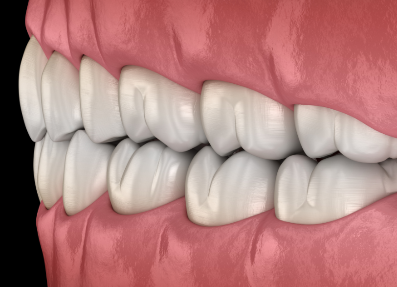 噛み合わせ治療のメリット|ホワイトエッセンス吉田