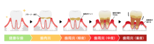 歯周病の進行｜ホワイトエッセンス吉田