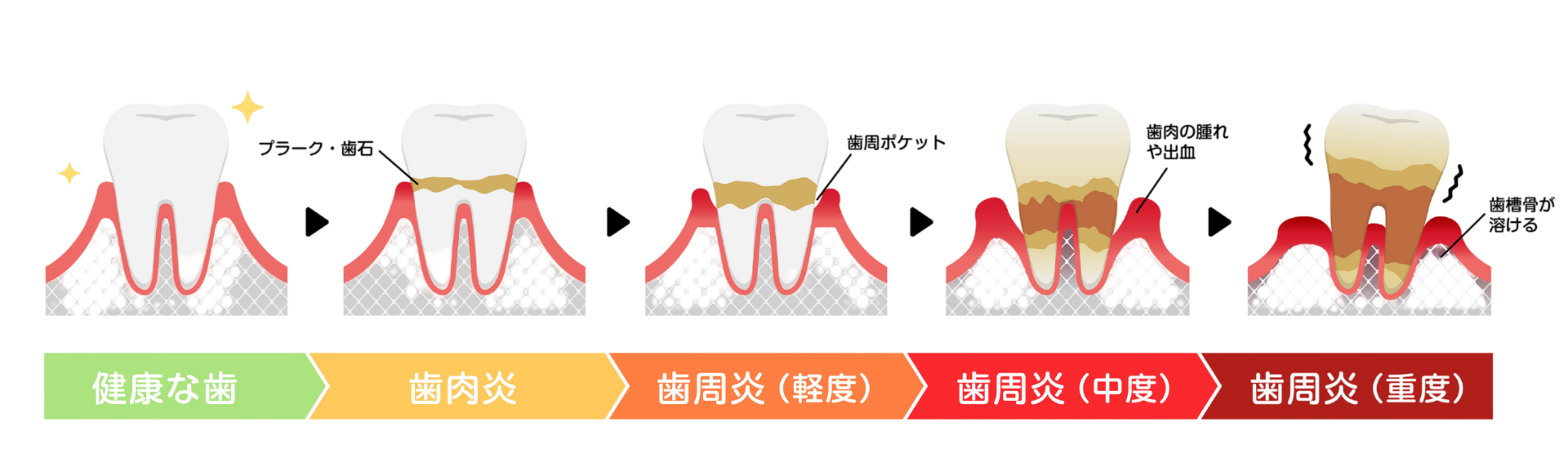 歯周病の進行｜ホワイトエッセンス吉田