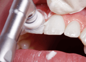 ポリッシングブラシとペースト｜ホワイトエッセンス吉田