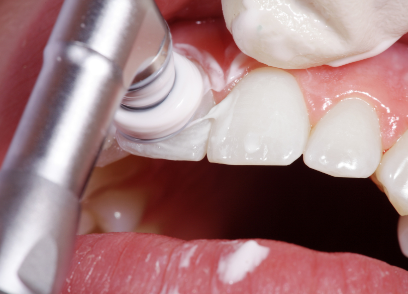 ポリッシングブラシとペースト｜ホワイトエッセンス吉田