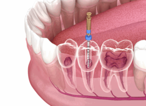 根管治療が必要｜ホワイトエッセンス吉田