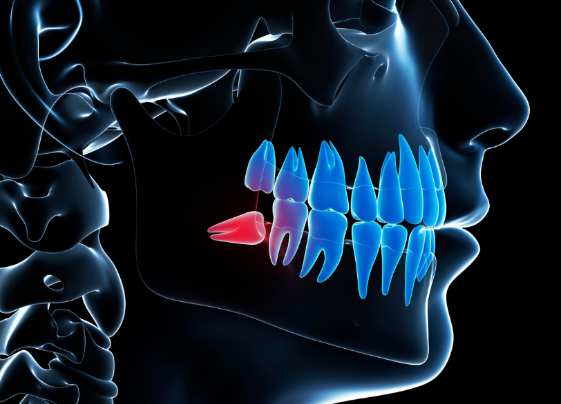 親知らずとは｜ホワイトエッセンス吉田