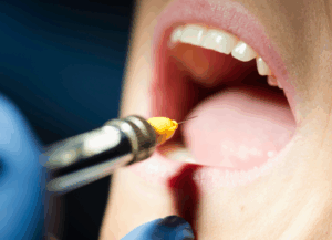 歯科用麻酔｜ホワイトエッセンス吉田