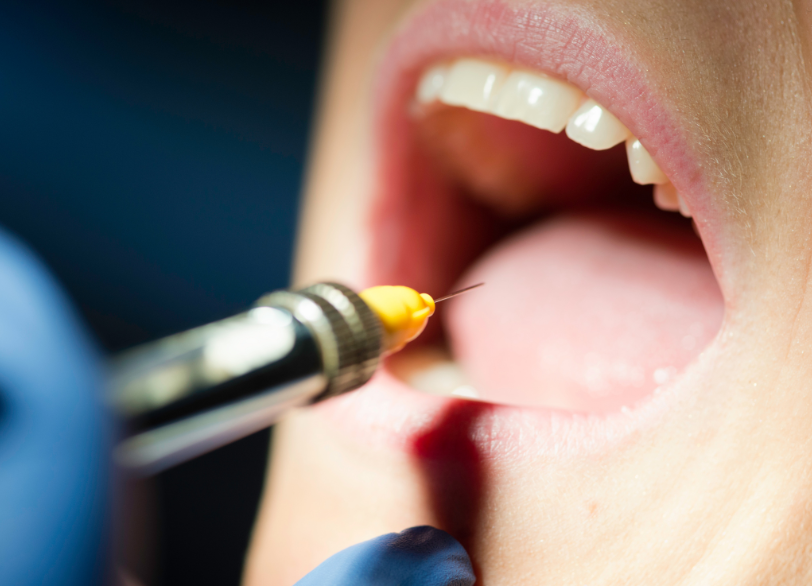 歯科用麻酔｜ホワイトエッセンス吉田