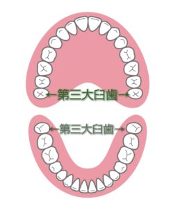 瑞穂市　歯医者　親知らず　吉田歯科医院