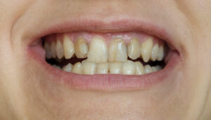 瑞穂市　歯医者　歯の黄ばみの原因　吉田歯科医院