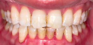 瑞穂市　歯医者　歯の黄ばみの原因　吉田歯科医院