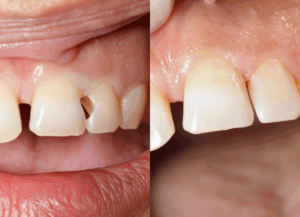 コンポジットレジン｜ホワイトエッセンス吉田