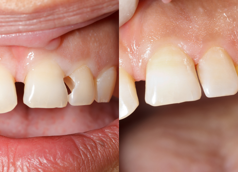 コンポジットレジン｜ホワイトエッセンス吉田