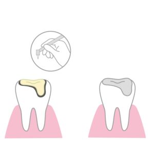 瑞穂市　歯医者　歯のライフサイクル　吉田歯科医院