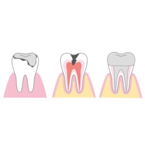 瑞穂市　歯医者　歯のライフサイクル　吉田歯科医院